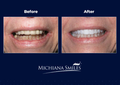 Crown and Veneers before after image - Michiana Smiles