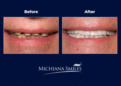 Crown and Veneers before after image - Michiana Smiles
