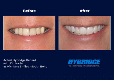 Hybridge Patient before after image - Michiana Smiles