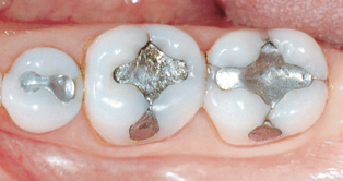 cerec restoration before with silver fillings