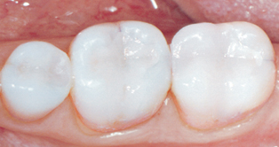 cerec restoration image of teeth